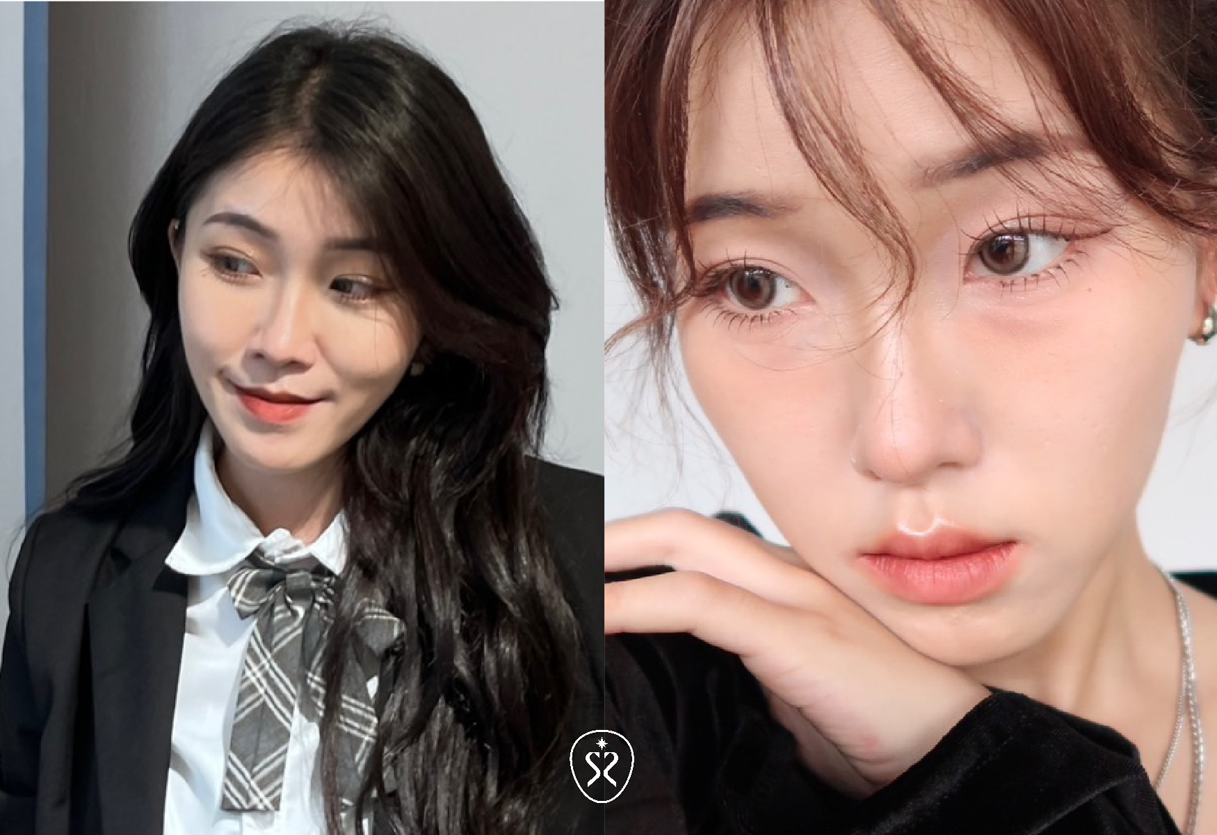 【玻尿酸淚溝及蘋果肌】